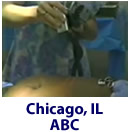 Laser Lipo Fat Burning